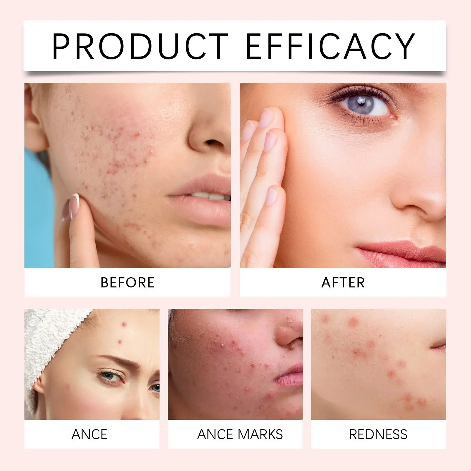 Invisible Colloidal Acne Patches with Tea Tree Oil & Calendula 9 HO A05 0359 01 1723861891017