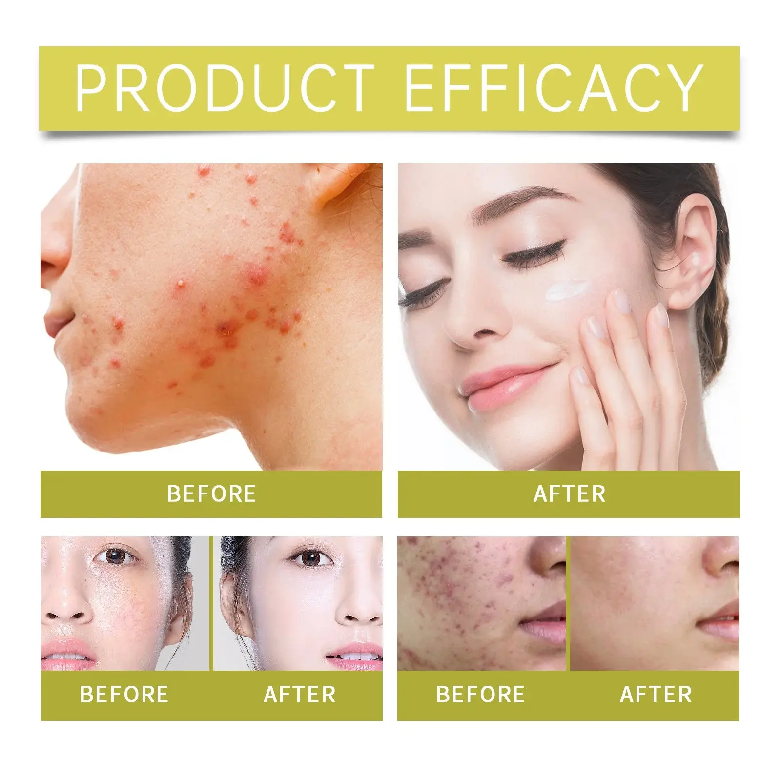 Beesvenom Acne-Clearing Cream - Oil Control & Moisturizing 10 HO A05 0575 01 1731294038021