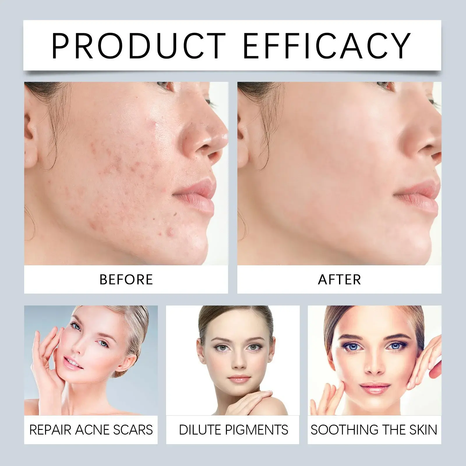 Acne Soothing Serum - Hydrating Moisturizer for Clearer Skin 9 HO A05 0604 01 1732075284022