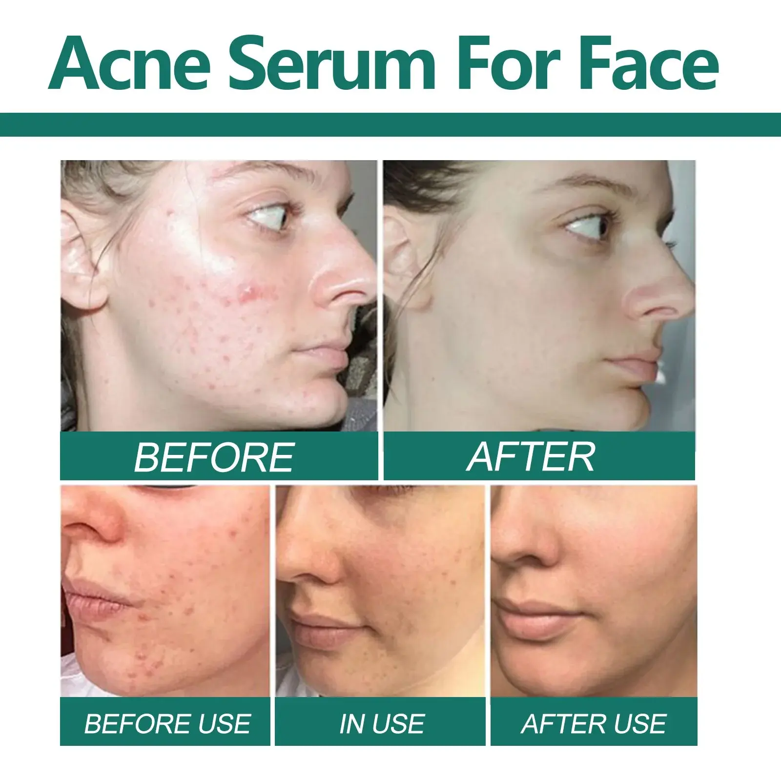 Acne Essence for Pore Care & Skin Brightening 8 HOA02 A039 30 WH1 17