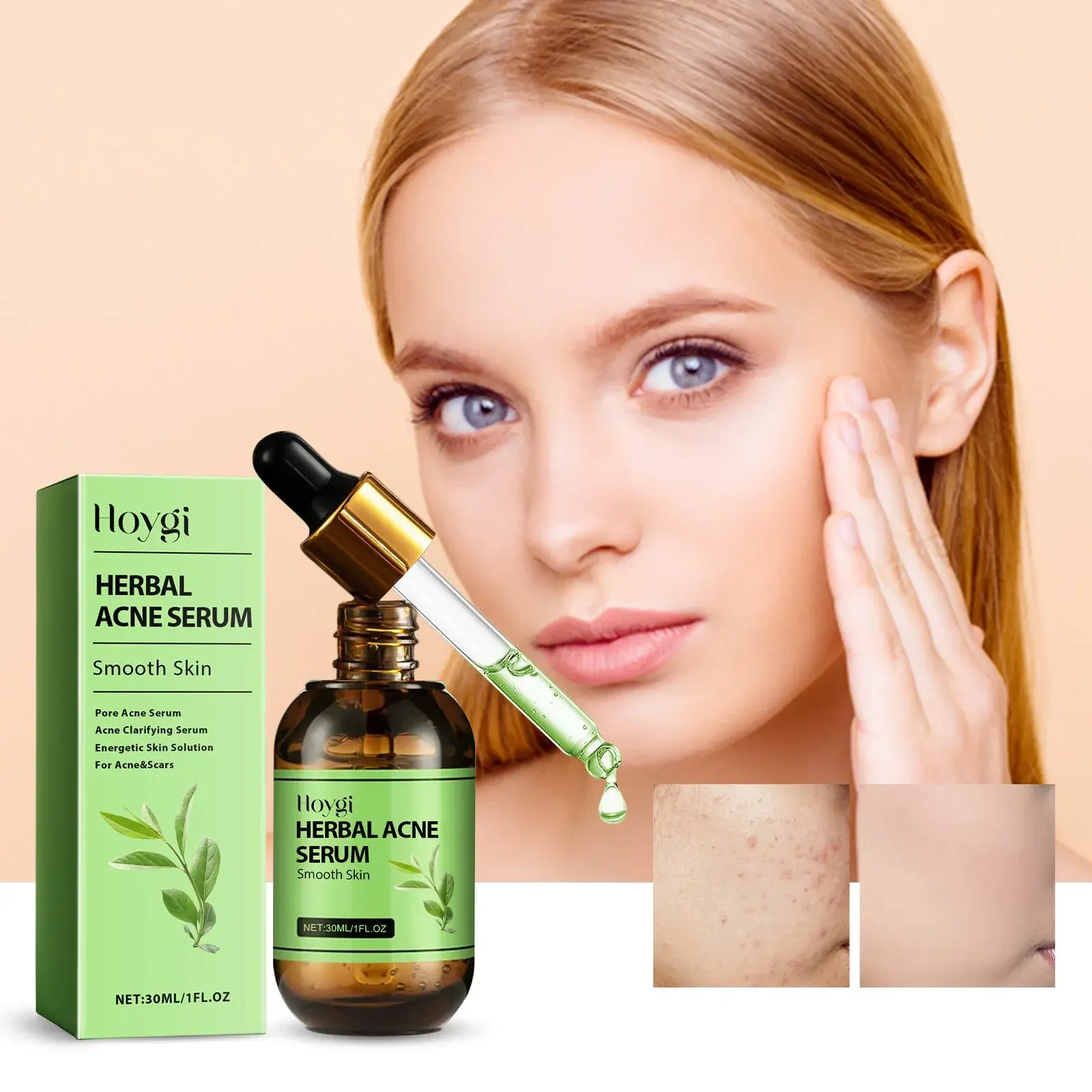 Herbal Acne Serum - Pore Cleansing & Skin Hydration 2 HOA05 A011 30 GN1 002
