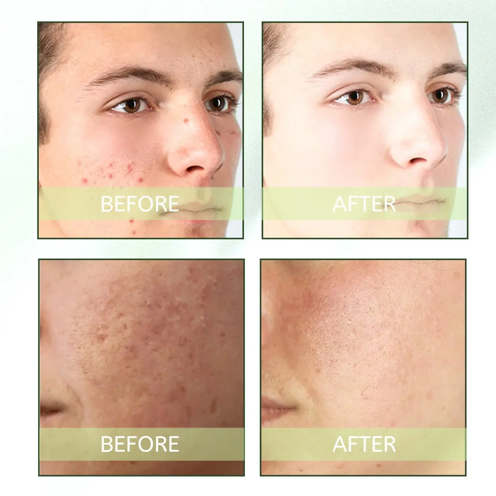 Herbal Acne Serum - Pore Cleansing & Skin Hydration 9 HOA05 A011 30 GN1 009