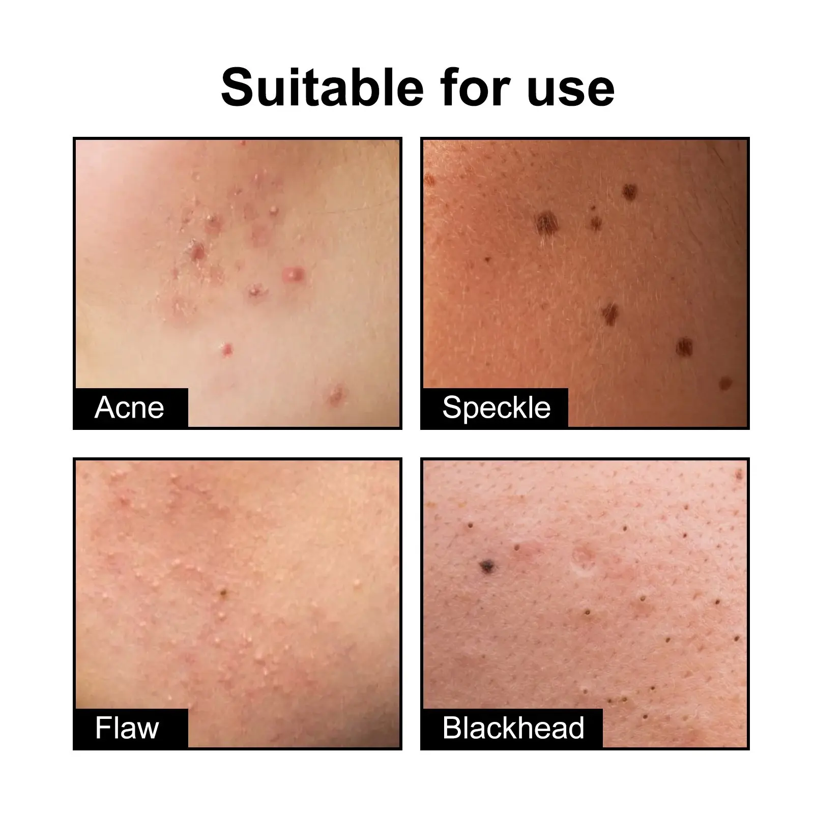 Cute Black Acne Patches for Pimple Treatment - Hoygi 7 HOA05 A027 108 BK1 008