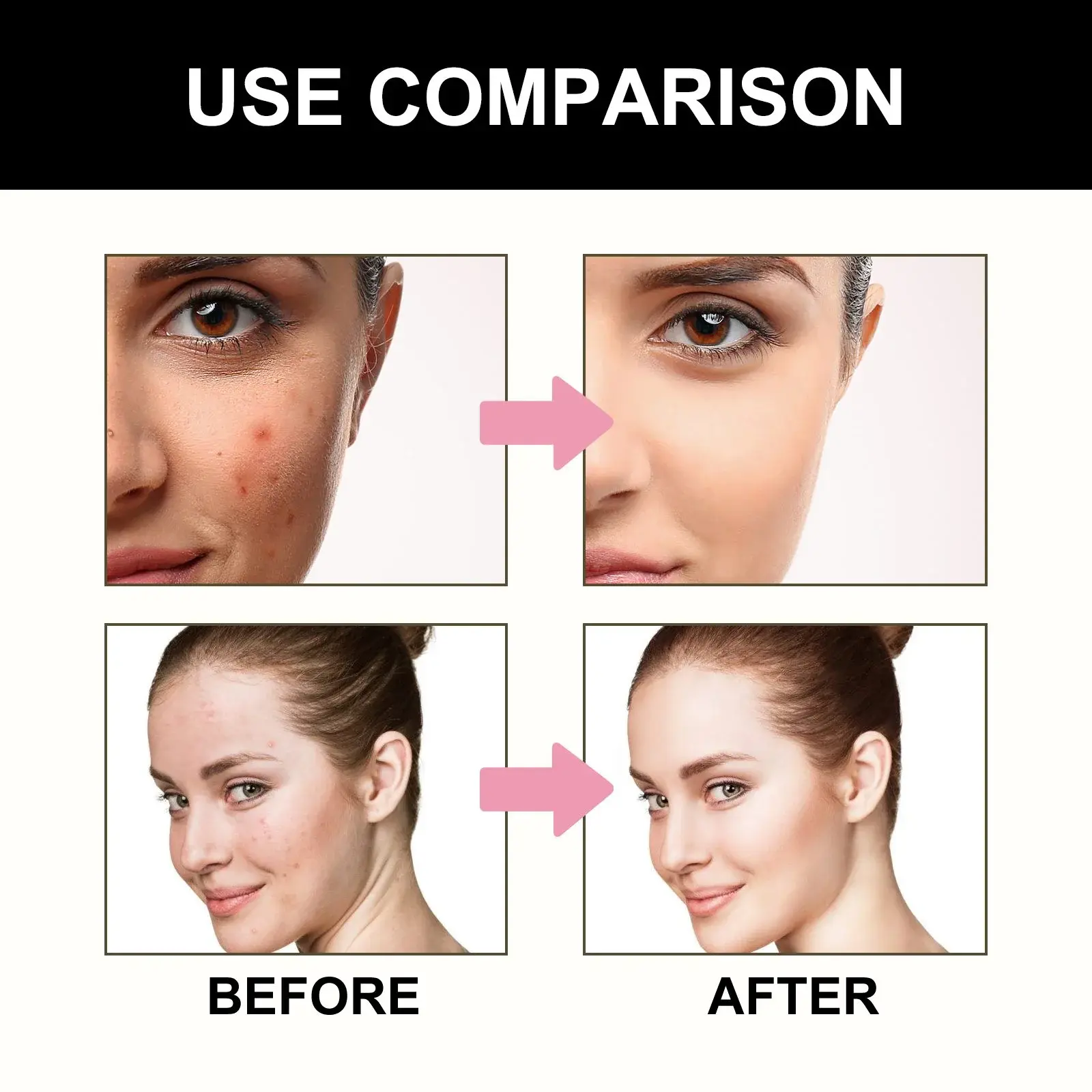 Cute Black Acne Patches for Pimple Treatment - Hoygi 9 HOA05 A027 108 BK1 010