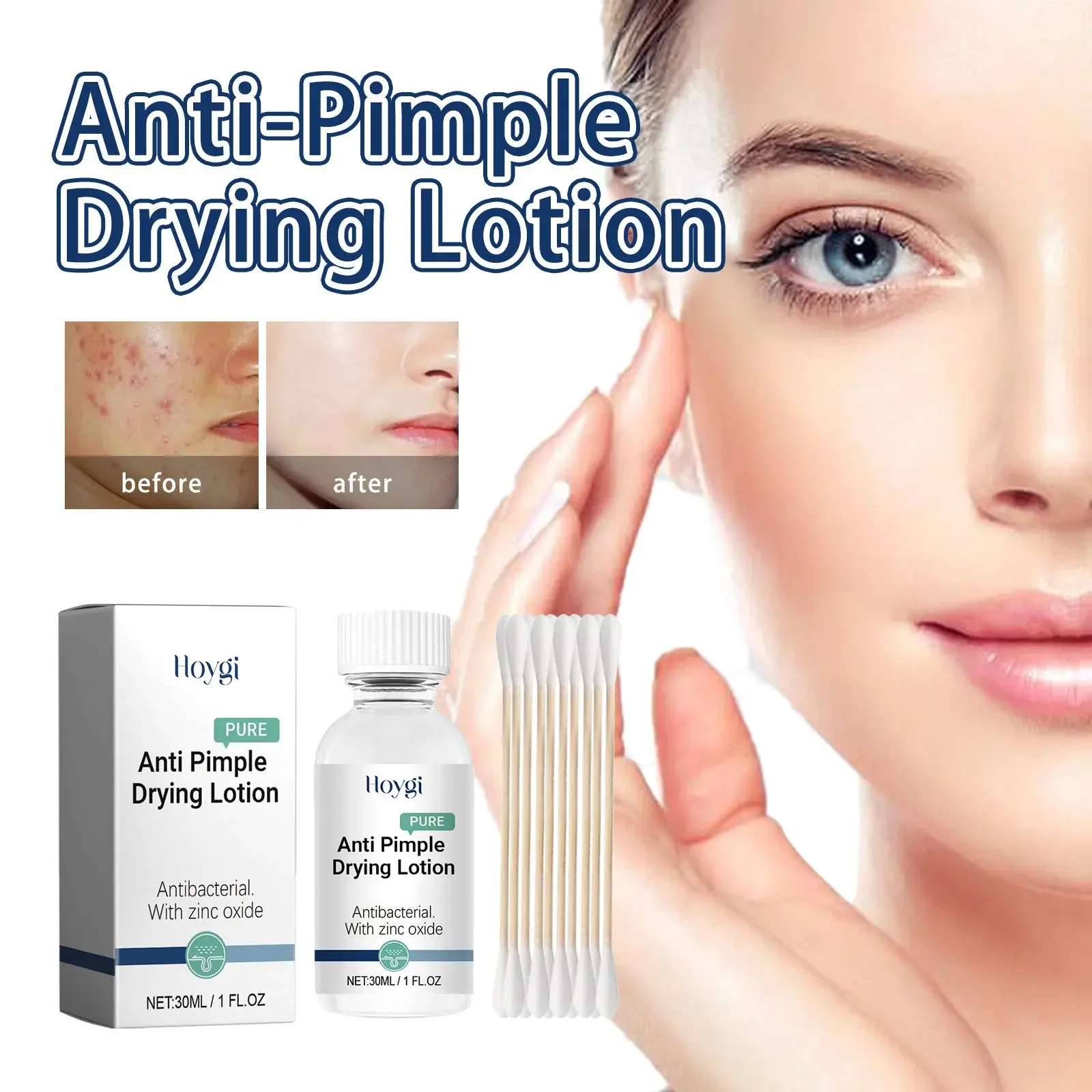 Anti-Pimple Drying Lotion for Acne Marks and Skin Pits 2 HOA05 A041 1 WH1 002