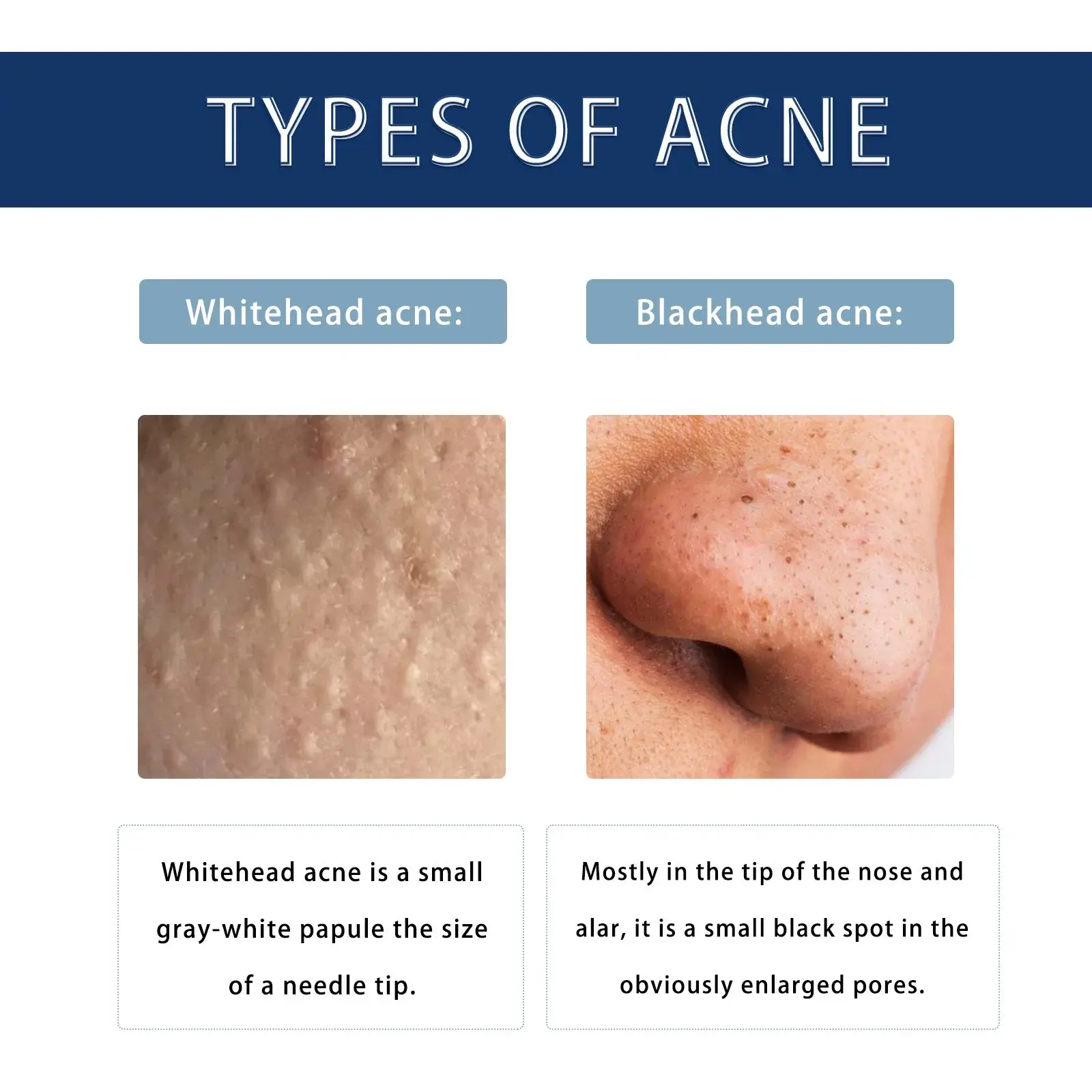 Anti-Pimple Drying Lotion for Acne Marks and Skin Pits 6 HOA05 A041 1 WH1 006