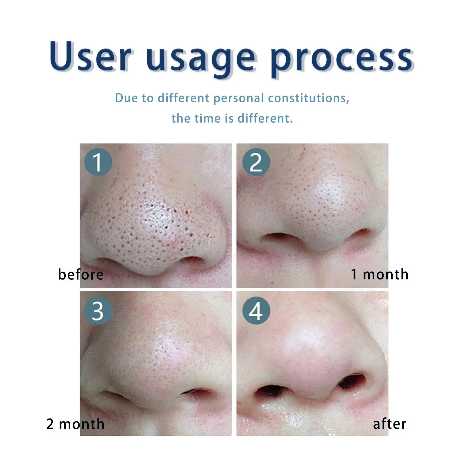 Anti-Pimple Drying Lotion for Acne Marks and Skin Pits 9 HOA05 A041 1 WH1 009