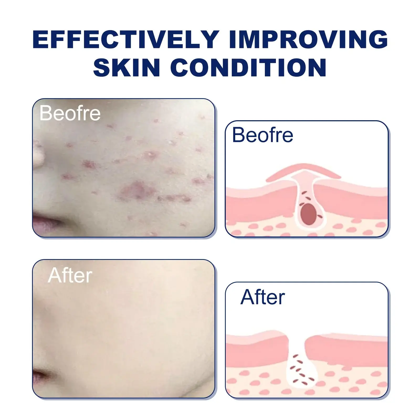 Acne Foaming Wash - Gentle Oil Control & Hydrating Cleanser 8 HOA05 A061 100 WH1 009