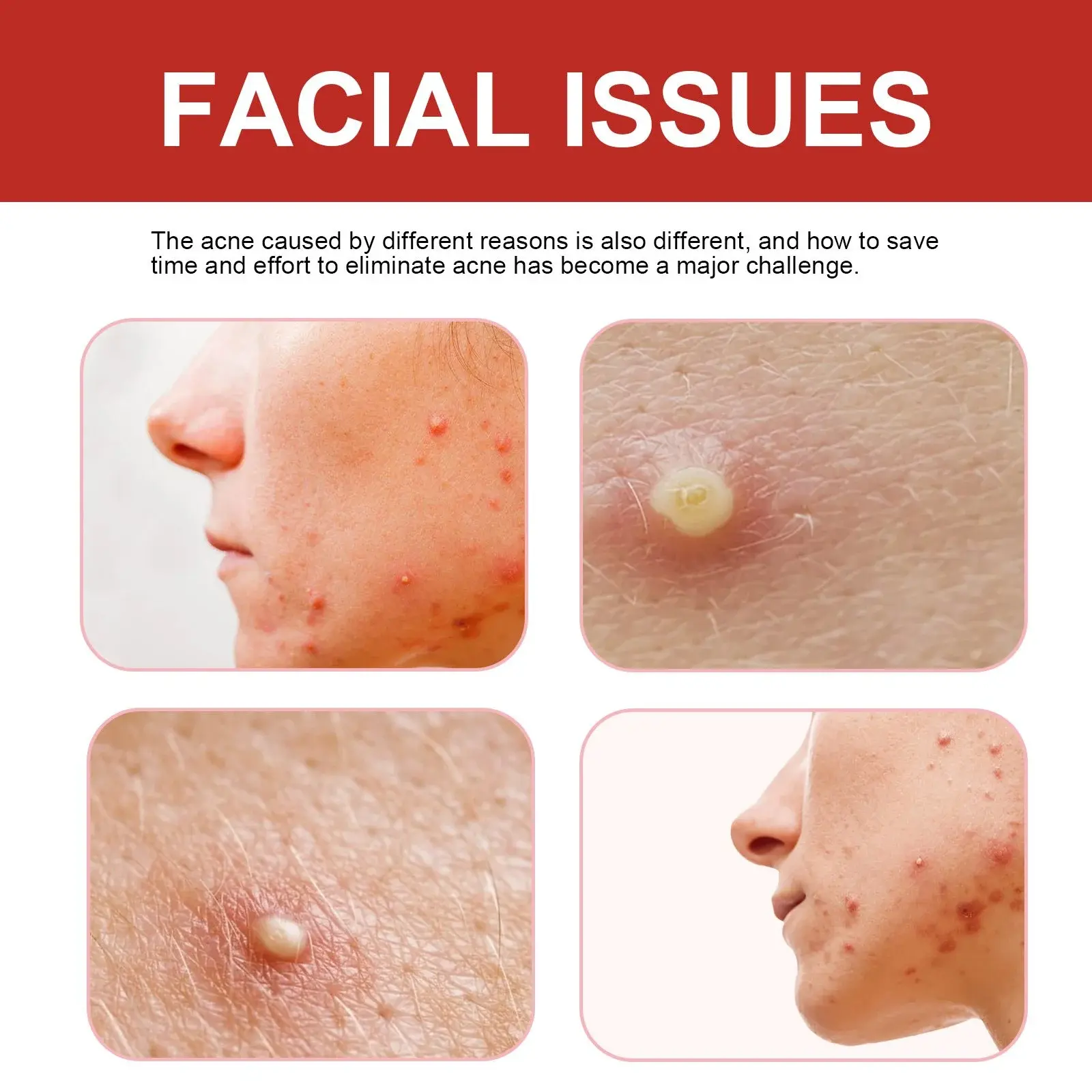 Cute Pimple Patches for Acne Care & Skin Support 7 HOB07 A001 249 RD1 008