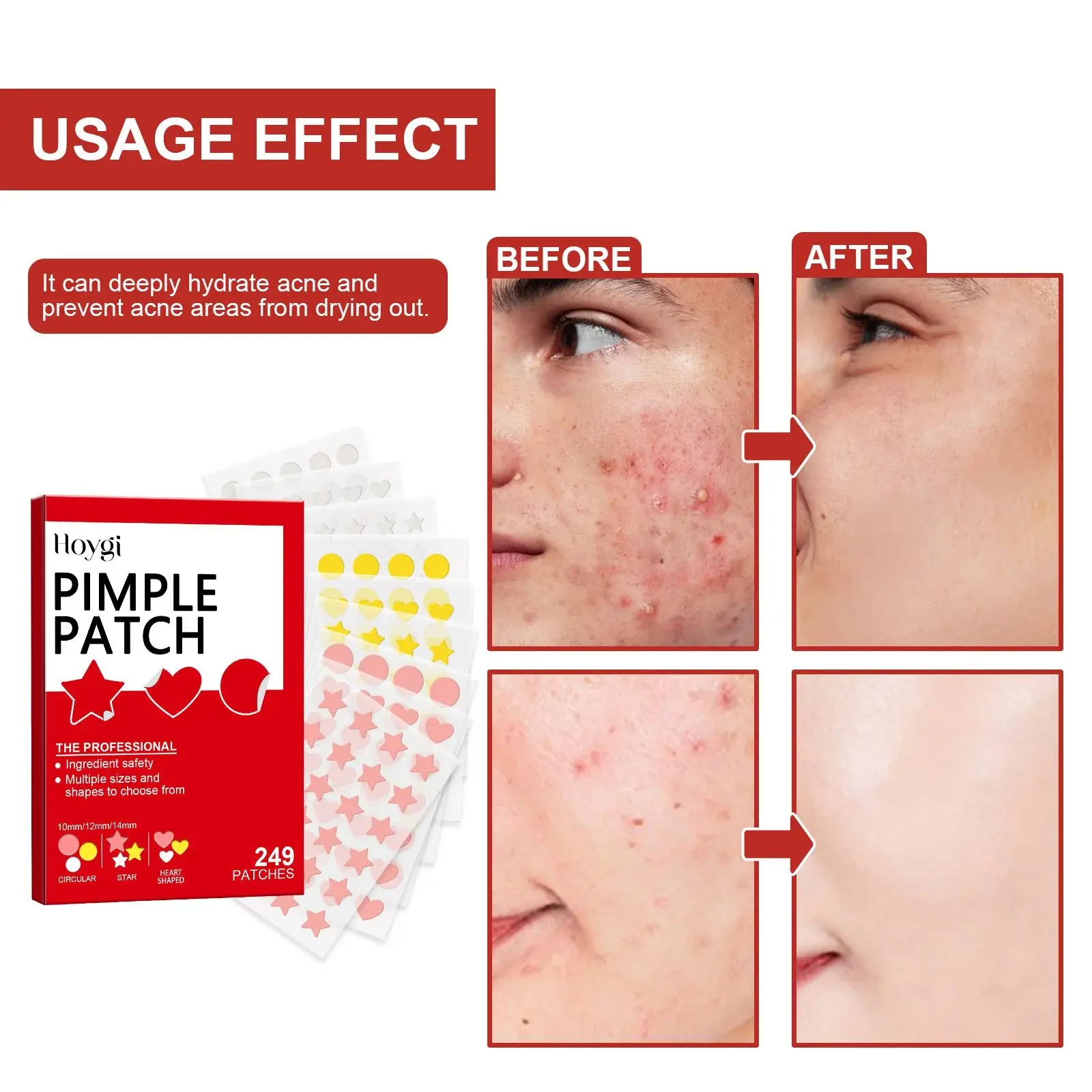 Cute Pimple Patches for Acne Care & Skin Support 9 HOB07 A001 249 RD1 010